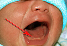 Что такое Жемчужина Эпштейна. Новорожденные (натальные) зубы