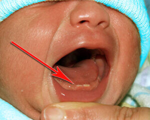 Что такое Жемчужина Эпштейна. Новорожденные (натальные) зубы
