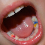 lechenie-kariesa-molochnyx-zubov