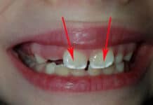 Почему на зубах белые пятна у ребенка?