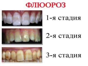 Флюороз. Стадии заболевания